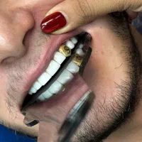 عیدانه کامپوزیت روکش طلا عصب ایمپلنت لمینیت دندان