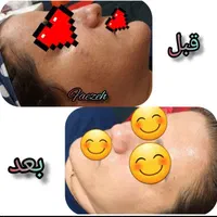 پاکسازی و فیشیال پوست|خدمات آرایشگری و زیبایی|یاسوج, |دیوار