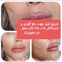 تزریق چربی صورت،ژل،بوتاکس،لیزر،لاغری|خدمات آرایشگری و زیبایی|رشت, گلسار|دیوار