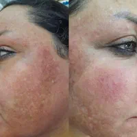 خدمات وآموزش پاکسازی پوست فیشیال فقط ویژه بانوان|خدمات آرایشگری و زیبایی|مشهد, طلاب|دیوار
