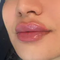 بوتاکس ، ژل و مزوتراپی و لیزر و کلیه خدمات زیبایی