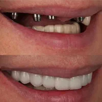 دندانپزشکی/ایمپلنت/اقساطی/زیبایی/کامپوزیت|خدمات آرایشگری و زیبایی|تبریز, |دیوار