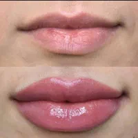ژل و بوتاکس و لیفت نخ مزوتراپی و آنزیم.فیلربادی|خدمات آرایشگری و زیبایی|کرج, مهرویلا جنوبی|دیوار