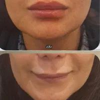 پوست صاف ویکدست میخوای متن آگهی روبخون+پیشنهادویژه|خدمات آرایشگری و زیبایی|قم, باجک دو|دیوار