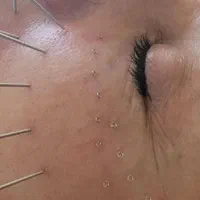 حجامت بختیاری ها،طب سنتی سوزنی ،فصد،زالو prp|خدمات آرایشگری و زیبایی|اصفهان, باغ دریاچه|دیوار