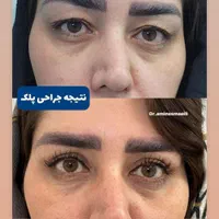 عمل جراحی پلک (بلفاروپلاستی)|خدمات آرایشگری و زیبایی|اصفهان, مسجد مصلی|دیوار