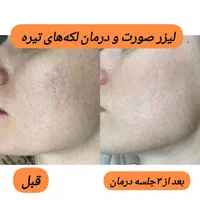 کیوسوئیچ، لیزر موهای زائد، هایفو، جوانسازی|خدمات آرایشگری و زیبایی|آبادان, |دیوار