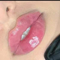 ژل و بوتاکس و لیفت نخ مزوتراپی و آنزیم.فیلربادی|خدمات آرایشگری و زیبایی|کرج, مهرویلا جنوبی|دیوار