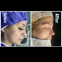 جراحی رینوپلاستی۲۷زیبایی بینی