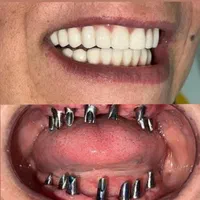 دندانپزشکی ایمپلنت اوردنچر روکش  تخصصی شمال غرب|خدمات آرایشگری و زیبایی|تبریز, |دیوار