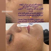 لیزر co2 فراکشنال و هایفوی پزشکی نه رومیزی|خدمات آرایشگری و زیبایی|اهواز, کیانپارس |دیوار