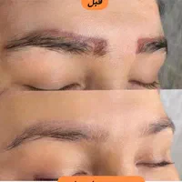 کیوسوئیچ، لیزر موهای زائد، هایفو، جوانسازی|خدمات آرایشگری و زیبایی|آبادان, |دیوار