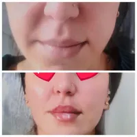 بوتاکس مصپورت فقط ۴۹۰ وفیلر ۵۹۰ پی ارپی ۸۵۰|خدمات آرایشگری و زیبایی|اصفهان, رزمندگان|دیوار
