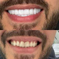 کامپوزیت دندان قیمت باورنکردنی