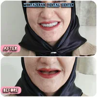 دندان مصنوعی/ دندانسازی ضمانتی/بیش ازنیم قرن تجربه