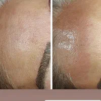 پلکسر مزو میکرونیلدینگ  رفع خال جوانسازی فیشیال|خدمات آرایشگری و زیبایی|مشهد, طلاب|دیوار