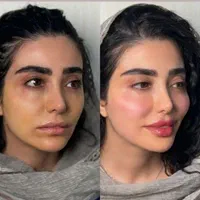 ژل لب/گونه/بوتاکس/فیلربینی/مزوپی ار پی