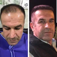 مرکز کاشت مو آتیه یزد|خدمات آرایشگری و زیبایی|یزد, |دیوار