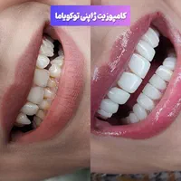 کامپوزیت،لمینیت،روکش،بلیچینگ در دندانپزشکی کیانمهر|خدمات آرایشگری و زیبایی|کرج, کیانمهر|دیوار