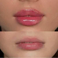 تزریق ژل لب و بوتاکس تضمینی