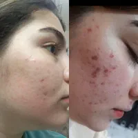 فشیال . مزونیدلینگ‌. خال برداری و آموزش