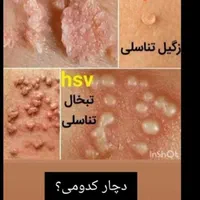 بهبود زگیل تناسلی و مشکلات جنسی