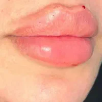 offژل و بوتاکسoff