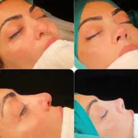 لیپو ابدو پروتز مامو لیفت شقیقه جراحی بینی بلفارو|خدمات آرایشگری و زیبایی|تهران, یوسف‌آباد|دیوار