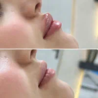 ژل /بوتاکس فیلر لب روسی اموزش بوتاکس آنزیم چربی|خدمات آموزشی|خرم‌آباد, |دیوار