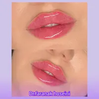 تخفیف تزریق ژل بوتاکس لیفت نخ هایفو فیلرلب لیزر|خدمات آرایشگری و زیبایی|تهران, سعادت‌آباد|دیوار
