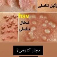 بهبودی کامل تبخال و زگیل