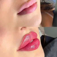 فیلر،ژل بوتاکس،آنزیم،فیلر بادی،پیرسینگ