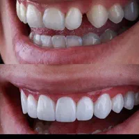 خدمات دندان پزشکی لمینت و کامپوزیت زیبایی|خدمات آرایشگری و زیبایی|تهران, جمهوری|دیوار