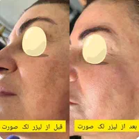 ریمو تتو و لک صورت با لیزر بدون زخم و نقاهت|خدمات آرایشگری و زیبایی|کرج, فاز ۲ مهرشهر|دیوار
