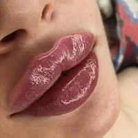تزریق ژل لب . بوتاکس با ماندگاری بالا لیزر PRP|خدمات آرایشگری و زیبایی|تهران, ستارخان|دیوار