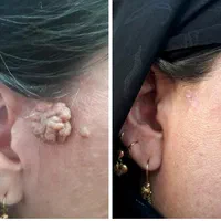 حذف خال ،میخچه ،زگیل فقط بامحلول گیاهی|خدمات آرایشگری و زیبایی|خمینیشهر, |دیوار