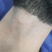 خدمات لیزر مردانه با دو دستگاه پیشرفته 2025|خدمات آرایشگری و زیبایی|تهران, یافت آباد جنوبی|دیوار