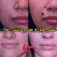 برداشتن انواع خال وکک ومک وزائده گوشتی