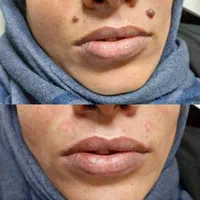 خال برداری و رفع انواع خال و خالبرداری|خدمات آرایشگری و زیبایی|اهواز, کیانپارس |دیوار