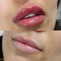 تزریق ژل لب و بوتاکس(پک 10cc)،جوانسازی و فیشال|خدمات آرایشگری و زیبایی|تهران, مهران (سیدخندان)|دیوار