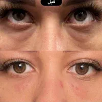 درمان قطعی و جوانسازی گودی .تیرگی و چروک زیر چشم|خدمات آرایشگری و زیبایی|مشهد, سناباد|دیوار