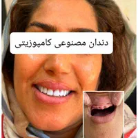 دندان مصنوعی پروتز ثابت، متحرک،کشیدن دندان|خدمات آرایشگری و زیبایی|کرمانشاه, |دیوار