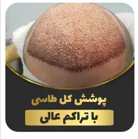 کاشت موی طبیعی|خدمات آرایشگری و زیبایی|اهواز, زیتون کارمندی|دیوار