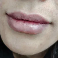 «تزریق ژل و بوتاکس کاشت مو و ابرو توسط پزشک»|خدمات آرایشگری و زیبایی|مشهد, گاز|دیوار