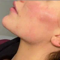 ژل لب و صورت بوتاکس|خدمات آرایشگری و زیبایی|رشت, گلسار|دیوار