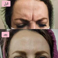 چربی بوتاکس ساکشن غبغب ژل مزو PRPتوسط پزشک مجرب|خدمات آرایشگری و زیبایی|زاهدان, |دیوار