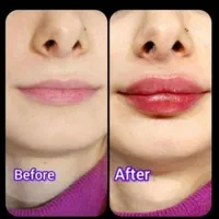 پوست مو زیبایی فیلر بوتاکس لیزر هایفو پی آرپی نخ