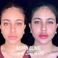 مدل فیلر لب روسی،کانتورینگ صورت،زاویه،چانه وشقیقه|خدمات آرایشگری و زیبایی|تهران, صادقیه|دیوار