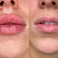 بوتاکس وژل.مزوسر   فقط۳۵۰|خدمات آرایشگری و زیبایی|کرج, بنیاد|دیوار