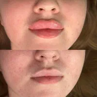 لیزرتیتانیوم،ژل لب فول فیس فیشیال مزو هایفو بوتاکس|خدمات آرایشگری و زیبایی|مشهد, آزادشهر|دیوار